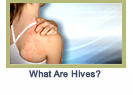 hives