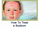 treatsunburn