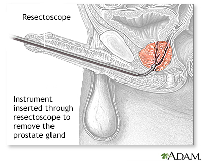 Procedure