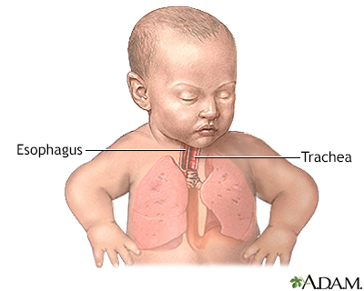 Tracheoesophageal fistula repair - series