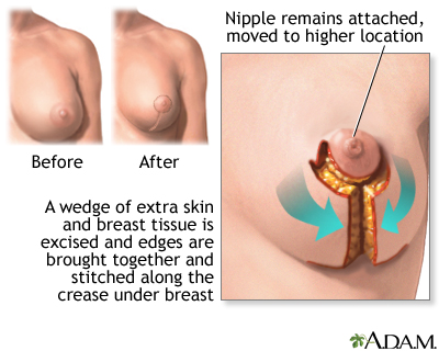 Mammoplasty