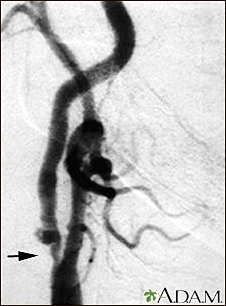 Carotid stenosis - X-ray of the right artery