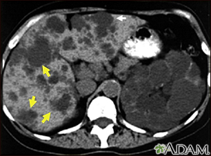 Kidney and liver cysts - CT scan