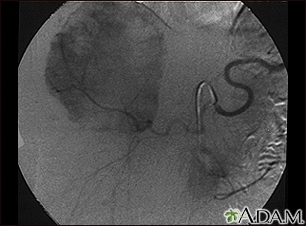 Hemangioma - angiogram