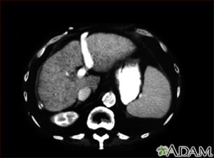 Liver cirrhosis - CT scan