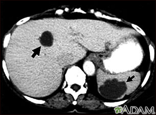 Liver and spleen cysts - CT scan