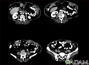 Peritoneal and ovarian cancer, CT scan