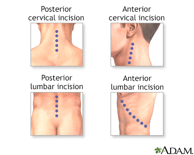 Incision