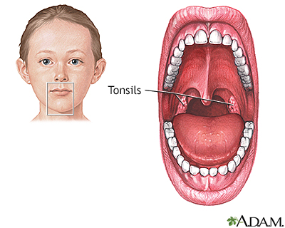 Tonsillectomy - Series