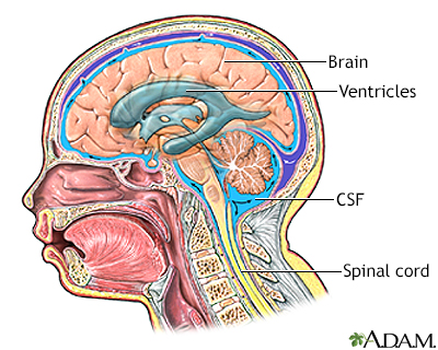 Ventriculoperitoneal shunt - series