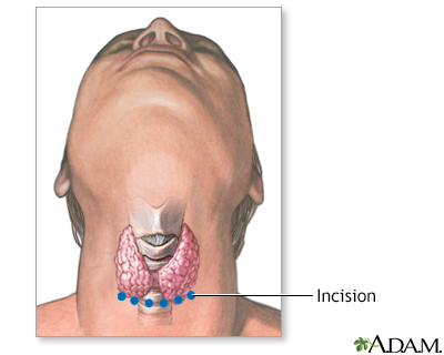 Incision