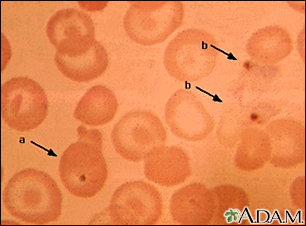 Malaria, photomicrograph of cellular parasites