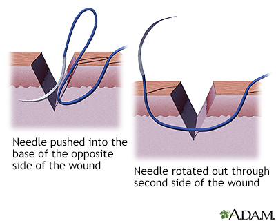 Sewing a wound closed, part 3