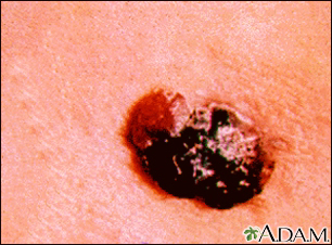 Skin cancer - raised multi-color melanoma