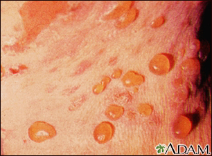 Bullous pemphigoid - close-up of tense blisters