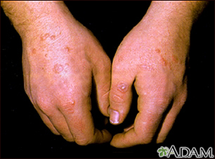 Erythema multiforme on the hands