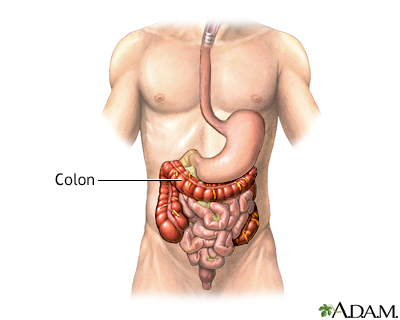 Colon diverticula - series