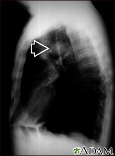 Pulmonary mass - side view chest X-ray