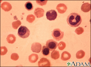 Erythroblastosis fetalis - photomicrograph