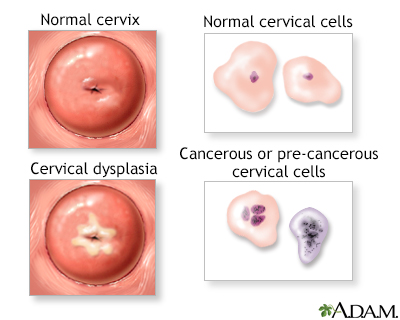 Cervical neoplasia