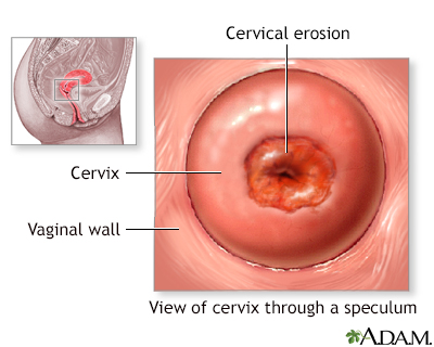 Cervical erosion