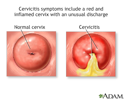 Cervicitis