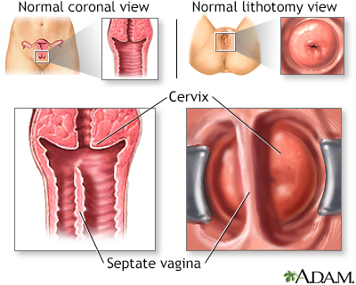 Developmental disorders of the vagina and vulva