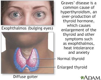 Graves disease