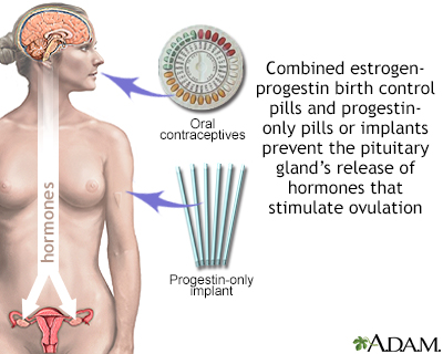 Hormone-based contraceptives