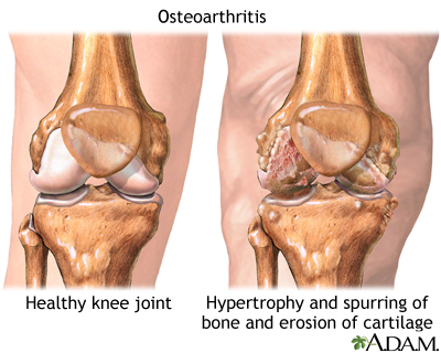 Osteoarthritis