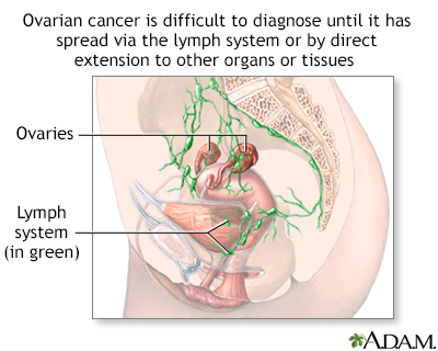 Ovarian cancer dangers