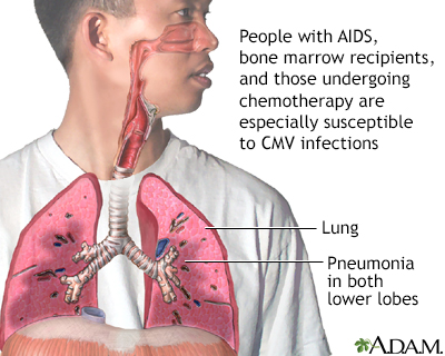 CMV pneumonia