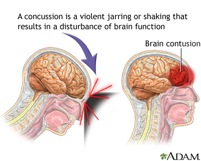 Concussion