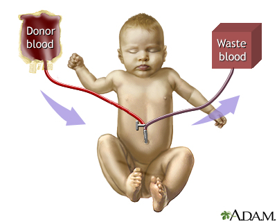 Exchange transfusion - Procedure