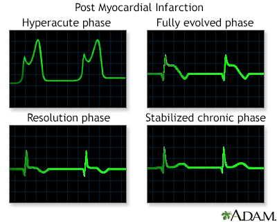 Post myocardial infarction ECG wave tracings