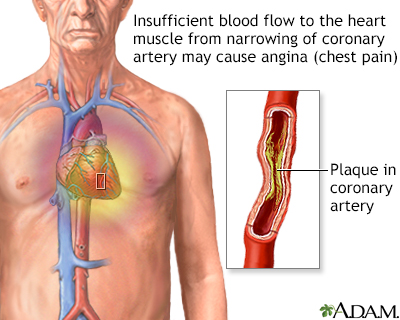 Stable angina