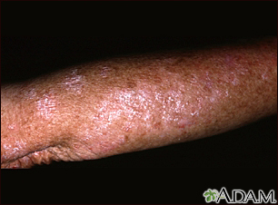 Actinic keratosis on the arm