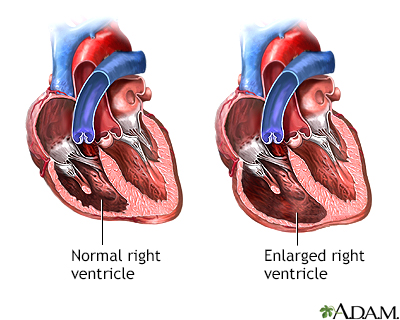 Tricuspid Regurgitation