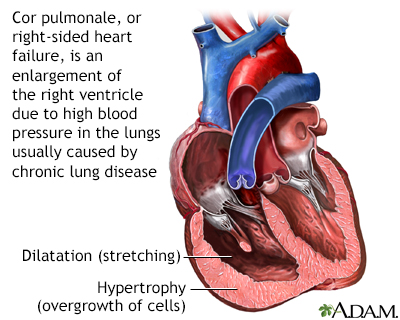 Cor pulmonale