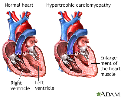 Hypertrophic cardiomyopathy