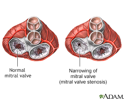 Mitral stenosis