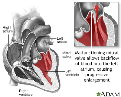 Mitral valve prolapse