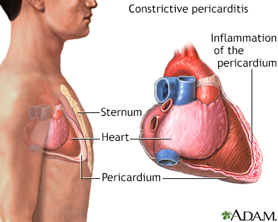 Constrictive pericarditis