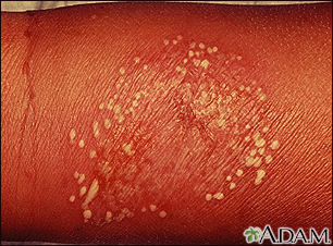 Pustules - superficial on the arm