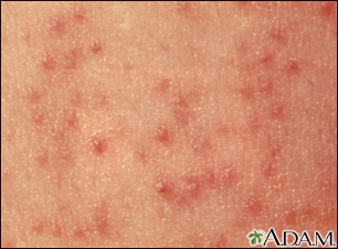 Keratosis pilaris - close-up