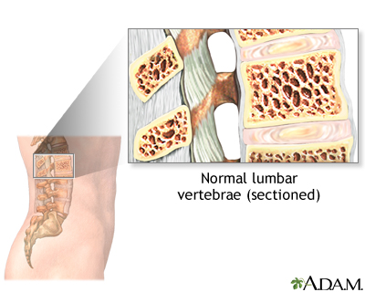 Vertebroplasty - series