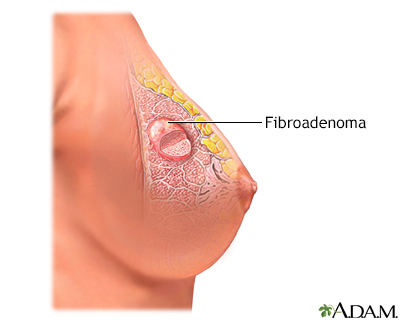 Fibroadenoma