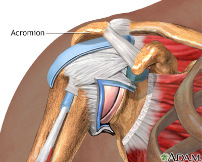 Impingement syndrome