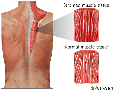 Muscle strain