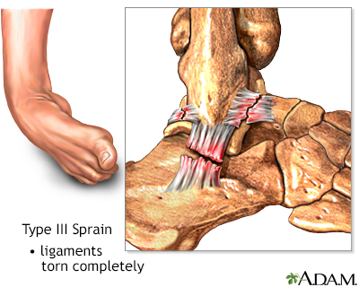 Type III ankle sprain